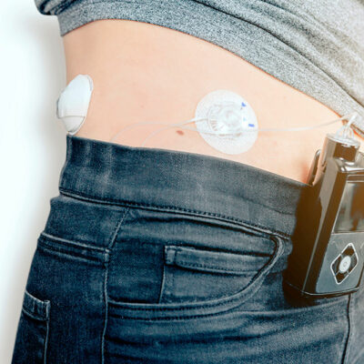 Insulin pumps &#8211; 3 best devices to buy in 2021