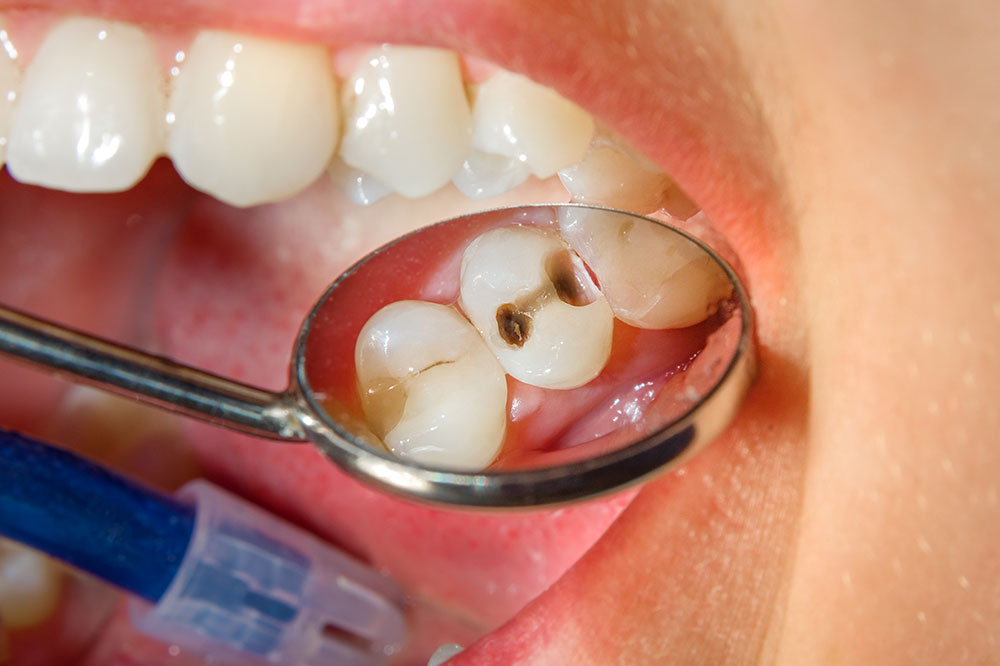 8 signs of dental issues due to high sugar intake